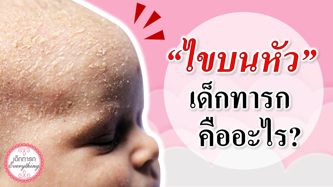 ไขบนหัวเด็กทารก คืออะไร?