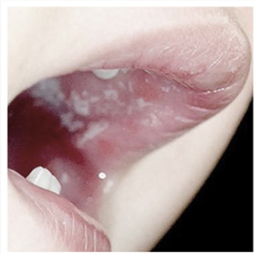 ผ้าเช็ดลิ้นทารก 0-6 เดือน