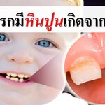 เด็กทารกมีหินปูนเกิดจากอะไร