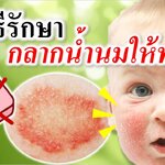 5 วิธีรักษากลากน้ำนม