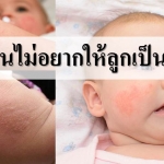 หน้าร้อนไม่อยากให้ลูกเป็นผดผื่น!!