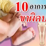 10 อาการขาทารกผิดปกติ